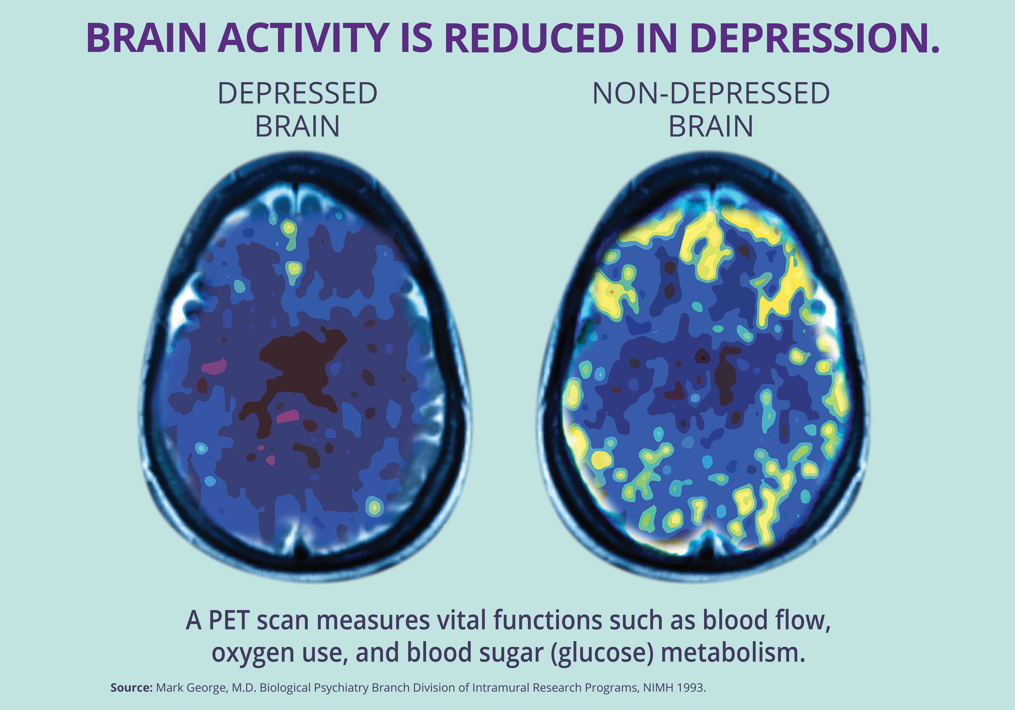 tms depression treatment boise meridian
